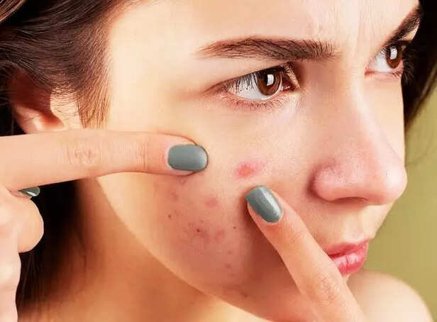 Chronic Acne